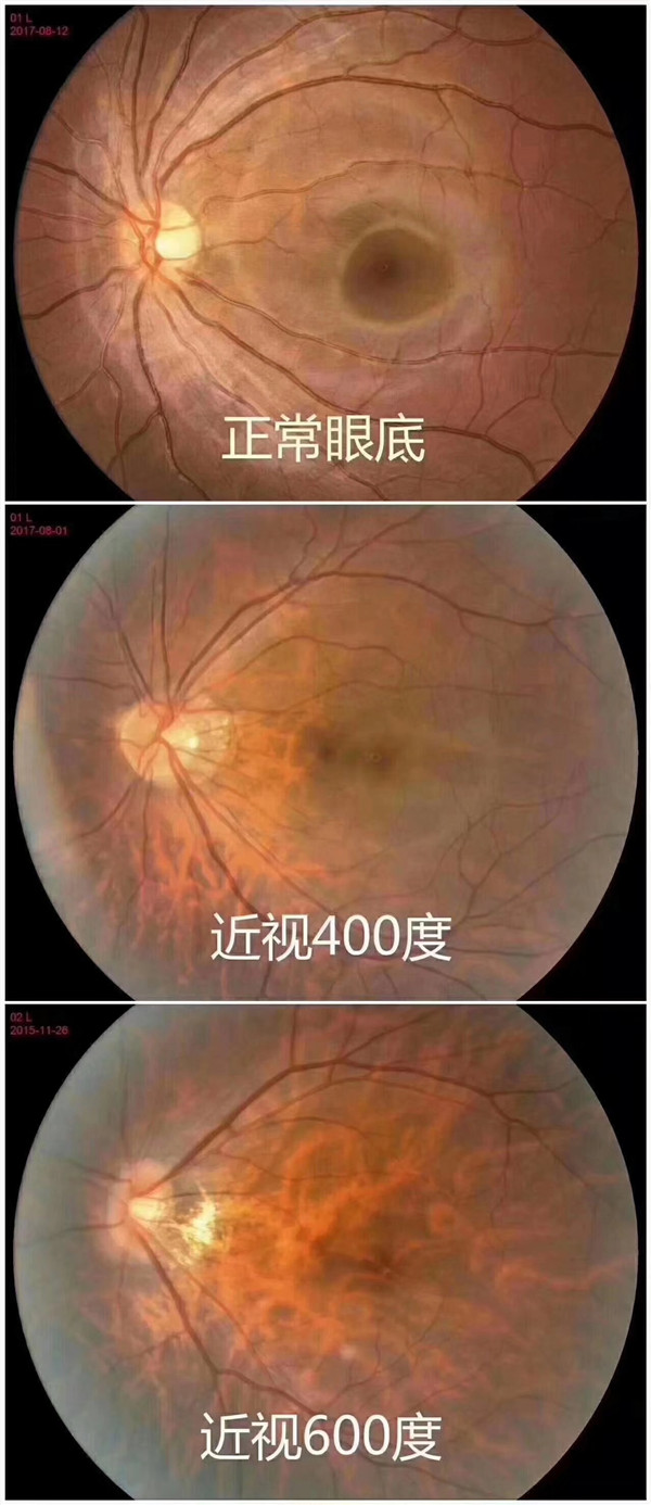 正常眼與近視眼的區(qū)別