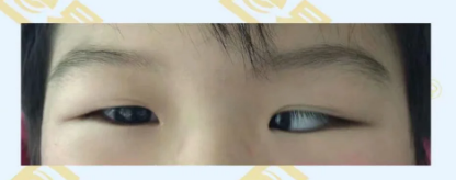 什么是先天性內(nèi)斜視？