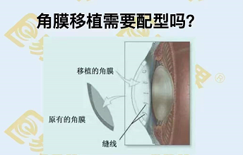 角膜移植需要配型嗎？